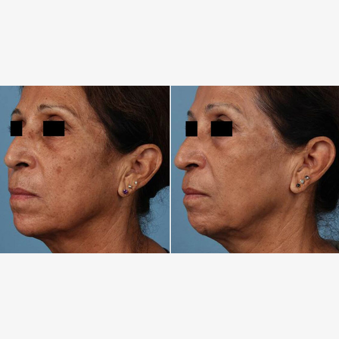 - Microblading Eyebrows in New York - Microblading training REJUVENATION PICOSURE NYC