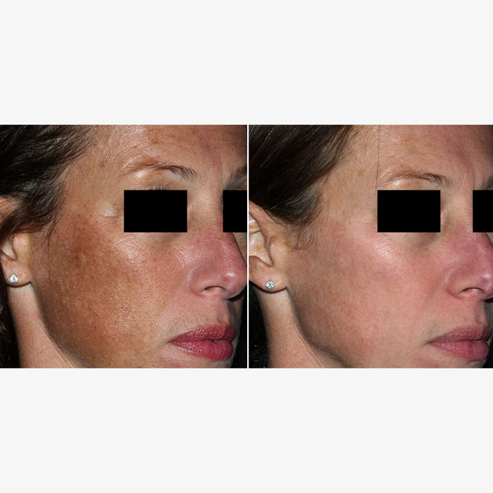 - Microblading Eyebrows in New York - Microblading training REJUVENATION PICOSURE NYC
