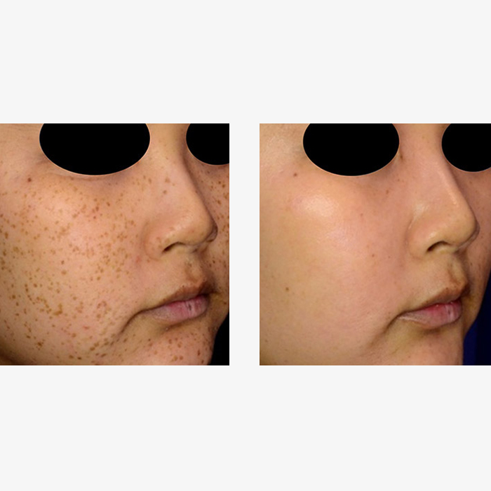- Microblading Eyebrows in New York - Microblading training REJUVENATION PICOSURE NYC