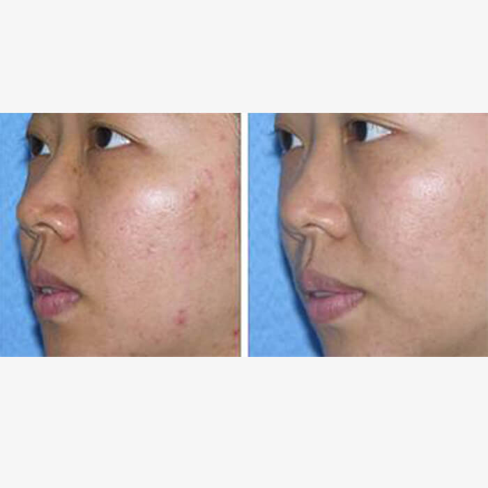 - Microblading Eyebrows in New York - Microblading training REJUVENATION PICOSURE