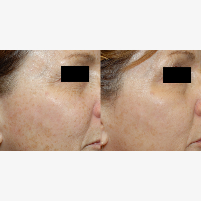 - Microblading Eyebrows in New York - Microblading training REJUVENATION PICOSURE
