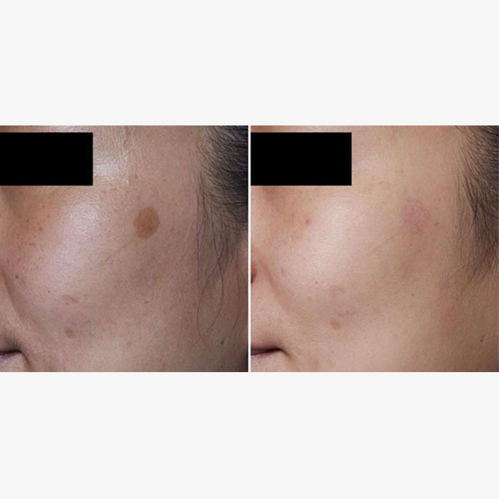 - Microblading Eyebrows in New York - Microblading training REJUVENATION PICOSURE
