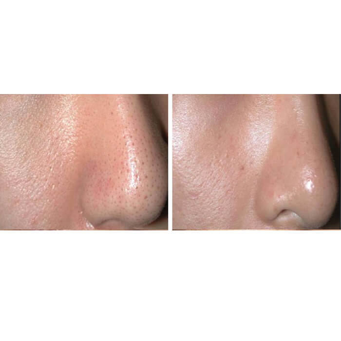 - Microblading Eyebrows in New York - Microblading training CARBON PEELING NYC