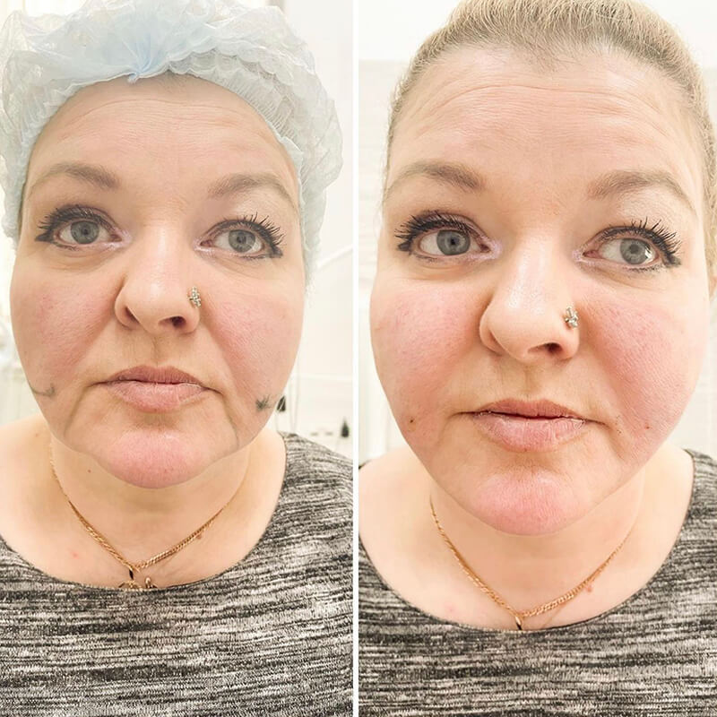 THREAD LIFT NEW YORK