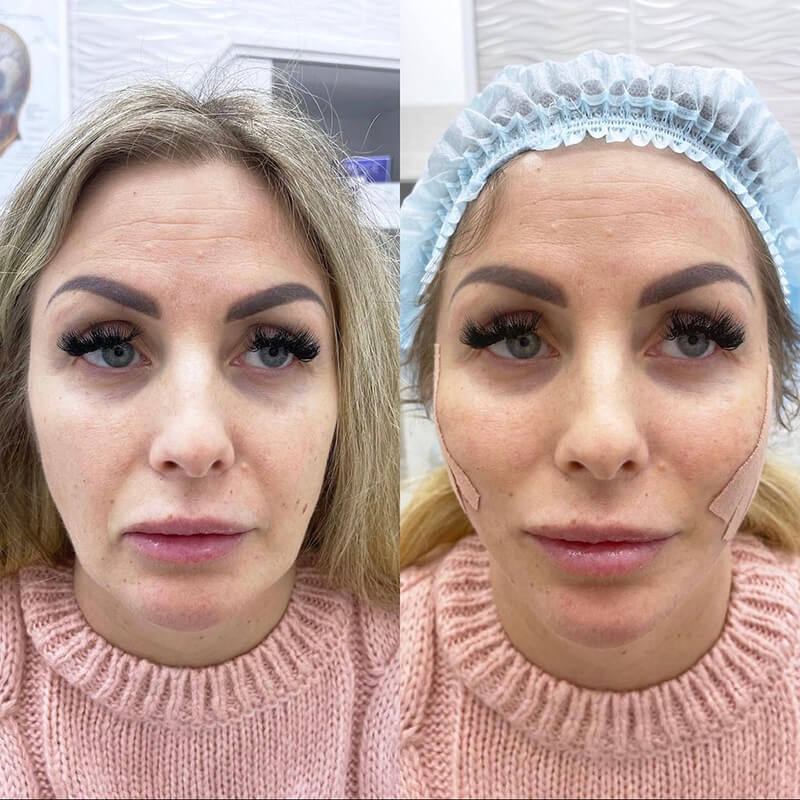 THREAD LIFT NEW YORK