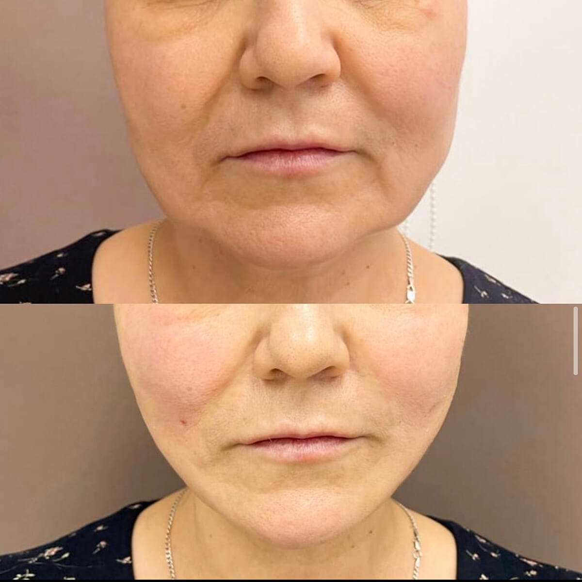 CONTOUR CORRECTION NEW YORK