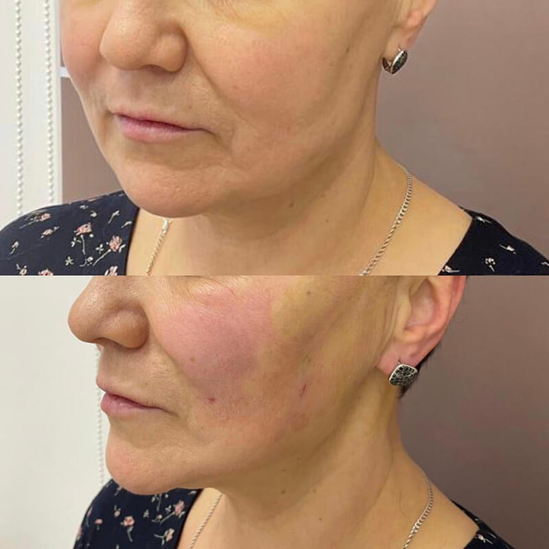 THREAD LIFT NEW YORK