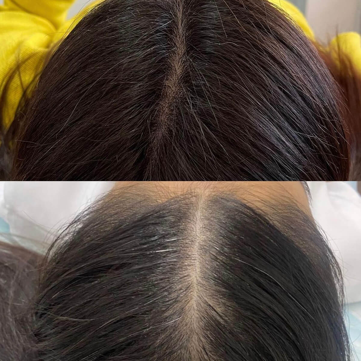 Best Mesotherapy Near Me in New York [WOWGIRLNYC®]