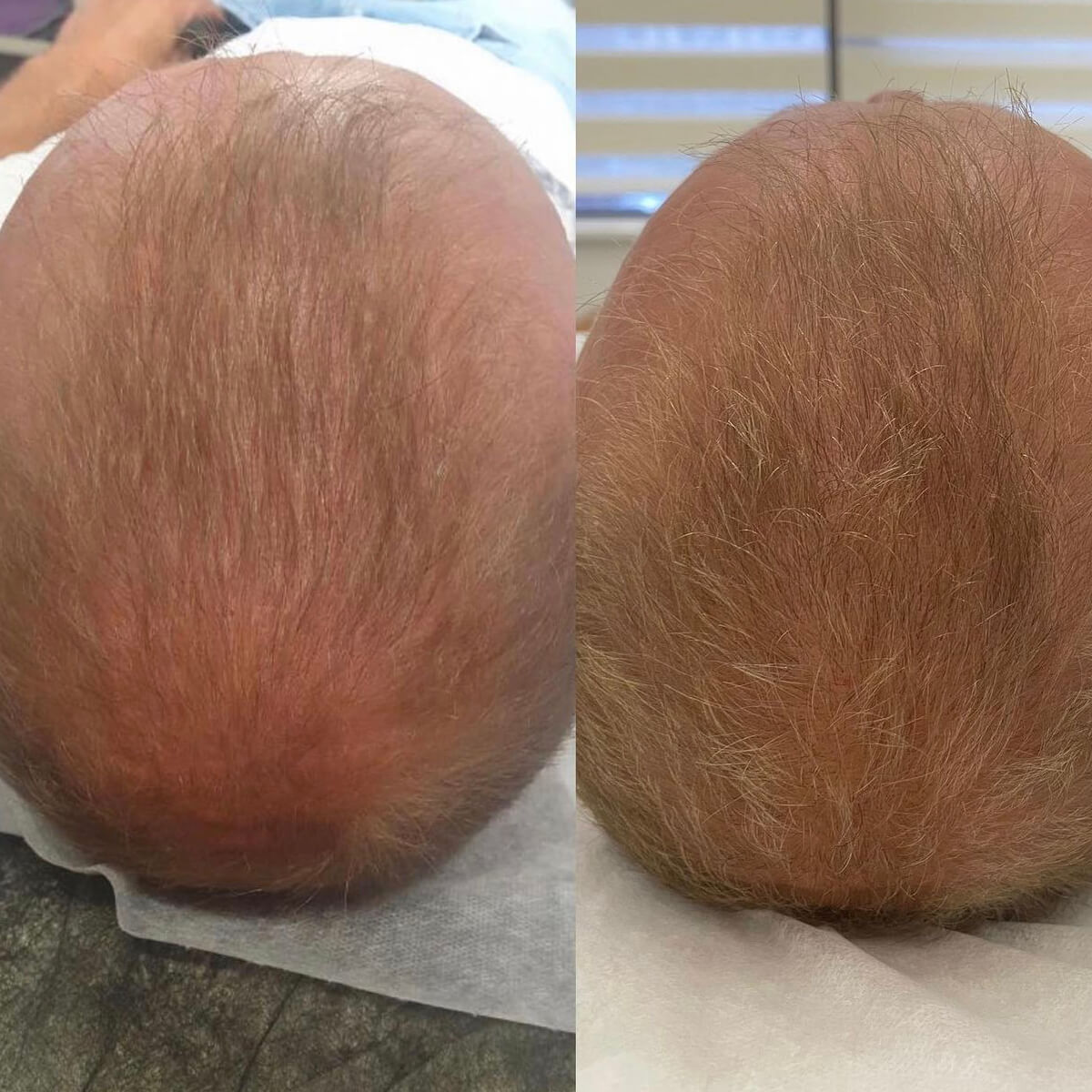 Best Mesotherapy Near Me in New York [WOWGIRLNYC®]