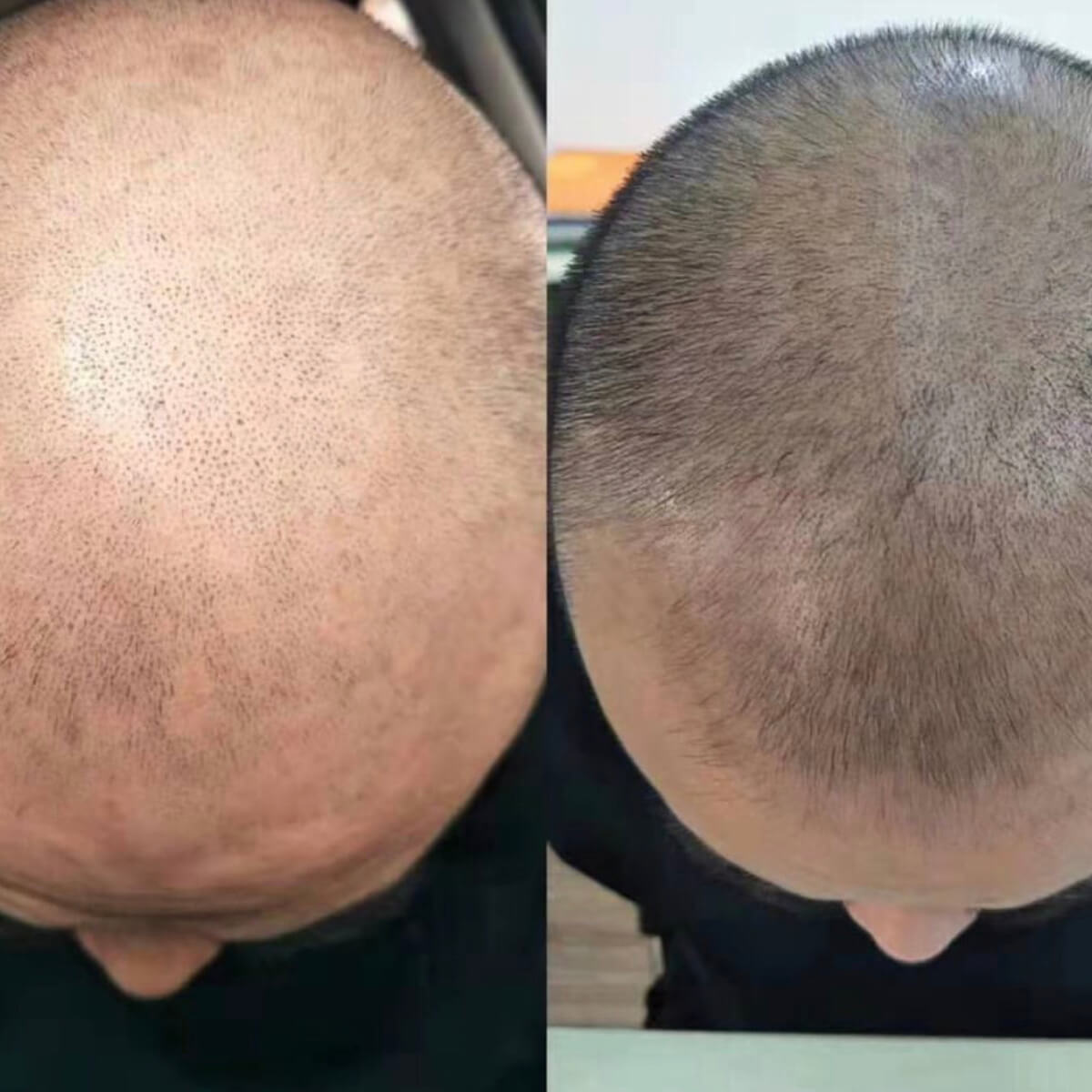 Best Mesotherapy Near Me in New York [WOWGIRLNYC®]