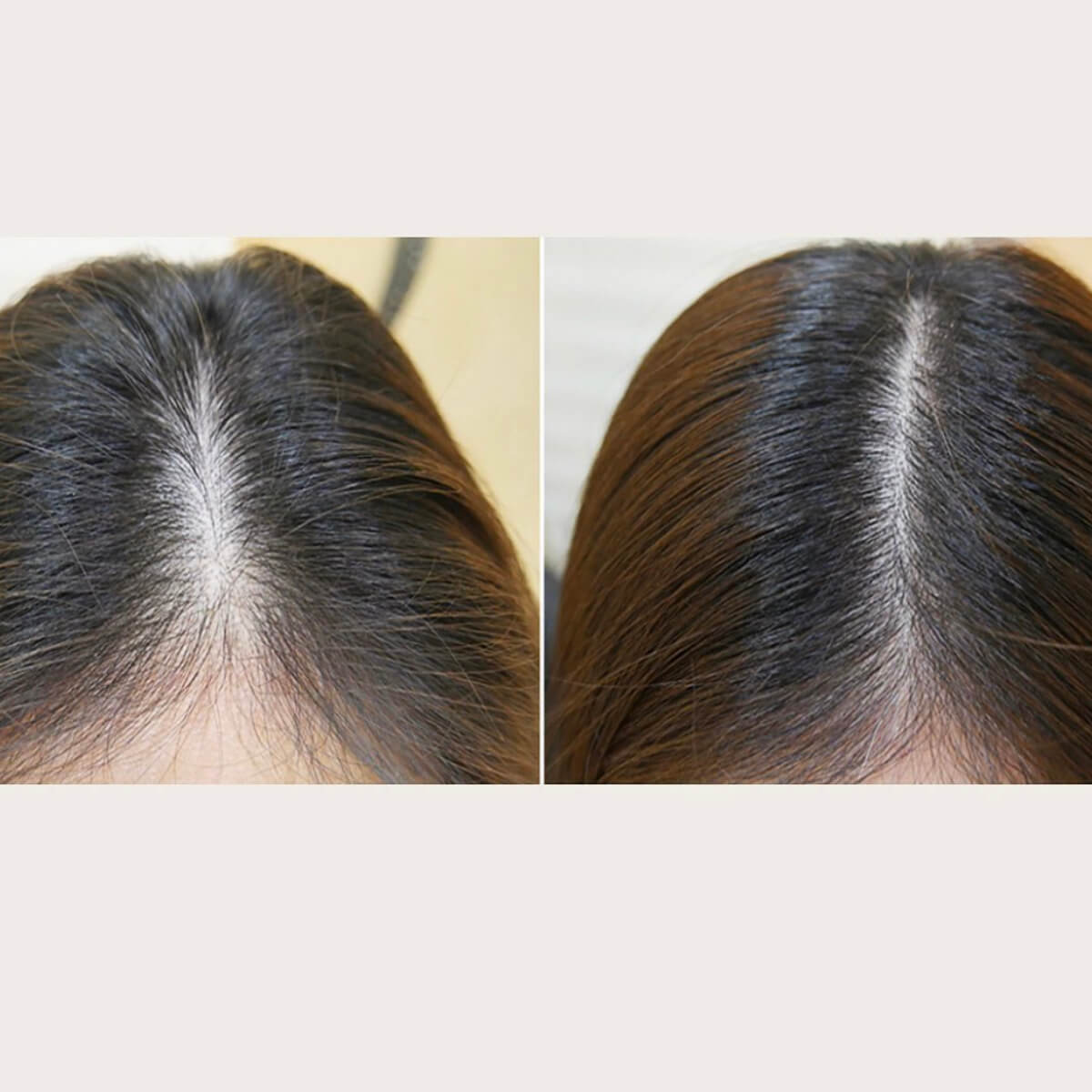 Best Mesotherapy Near Me in New York [WOWGIRLNYC®]