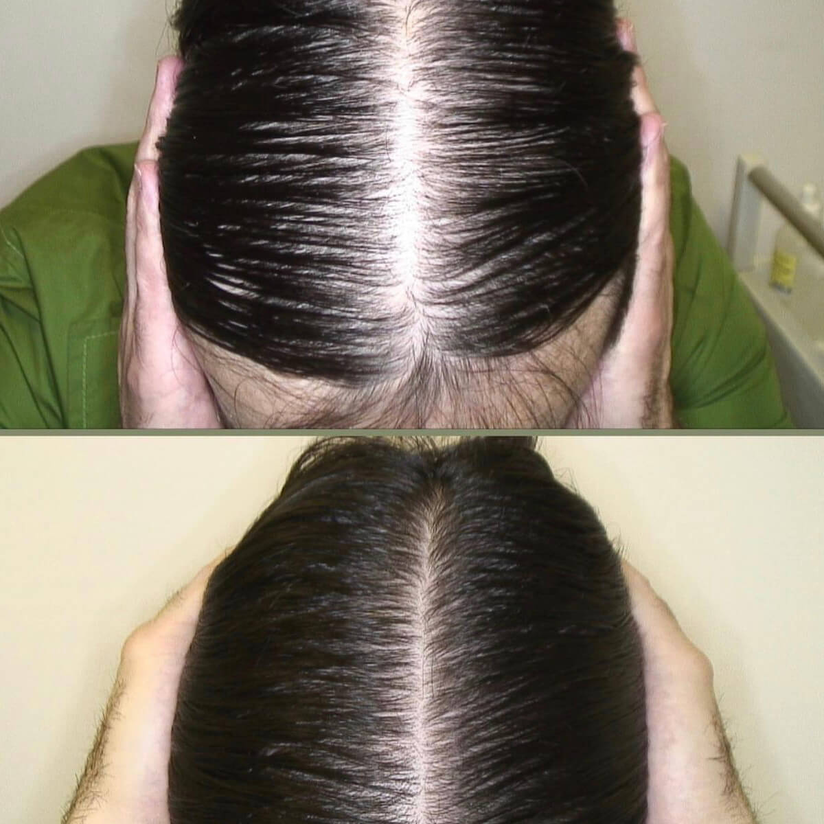 Best Mesotherapy Near Me in New York [WOWGIRLNYC®]