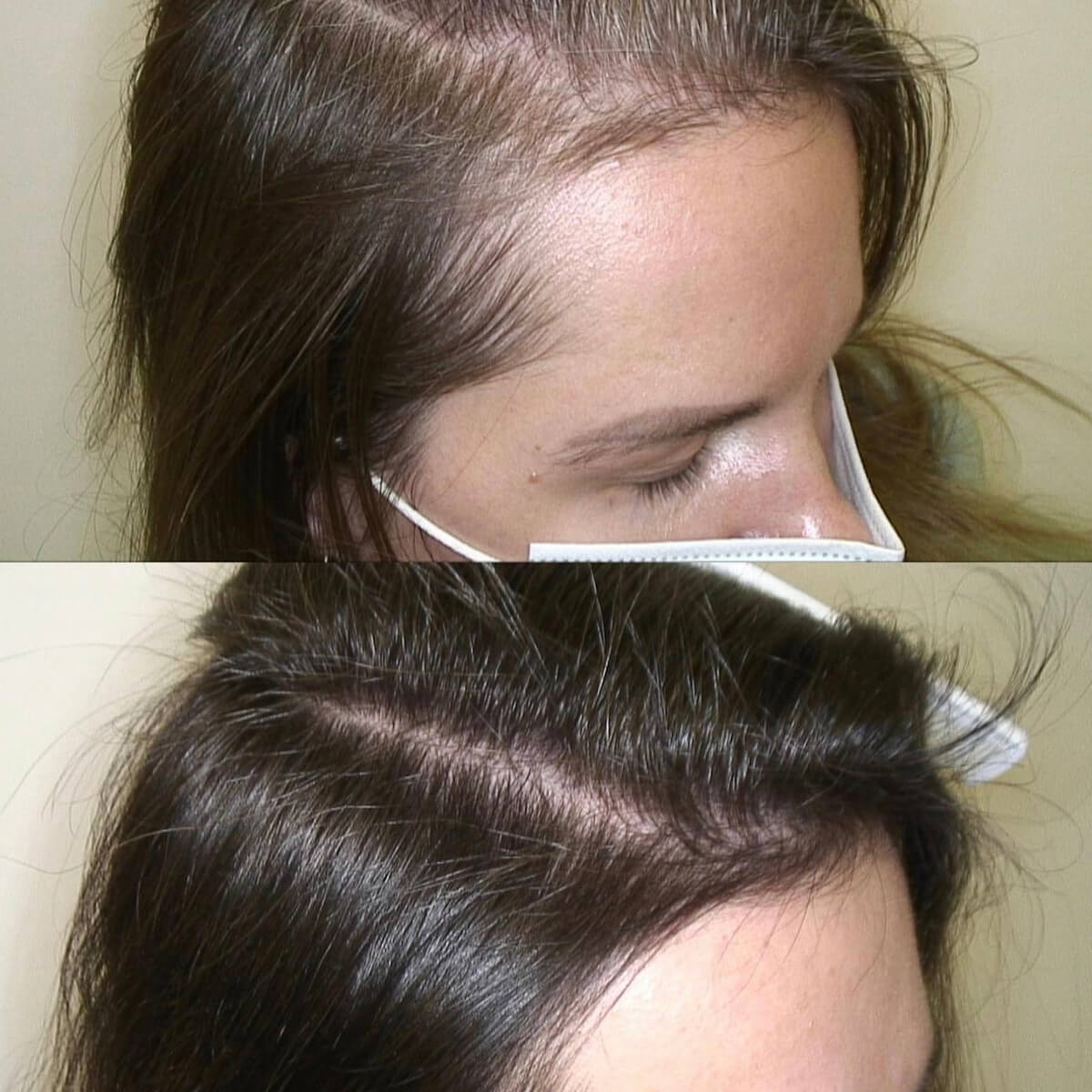 Best Mesotherapy Near Me in New York [WOWGIRLNYC®]