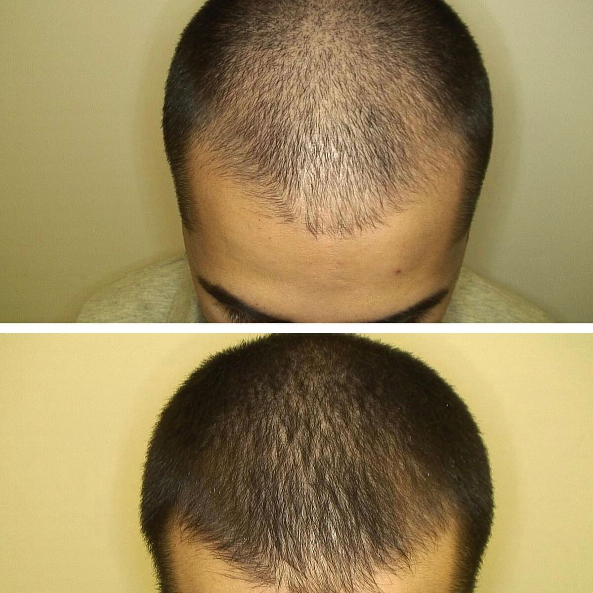 Best Mesotherapy Near Me in New York [WOWGIRLNYC®]