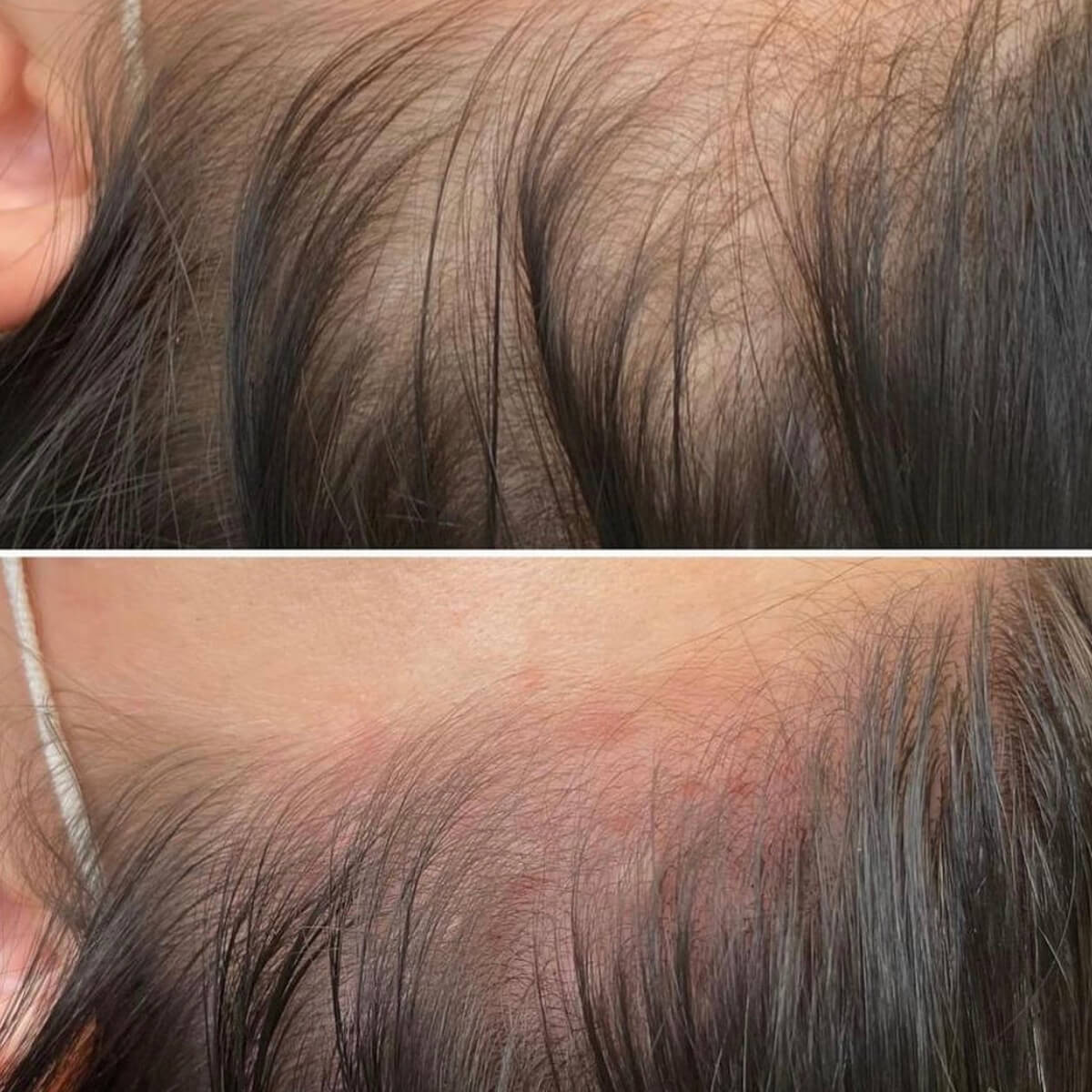 Best Mesotherapy Near Me in New York [WOWGIRLNYC®]