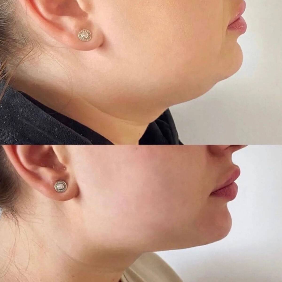 LIPOLYTIC INJECTIONS ( fat removal) NYC