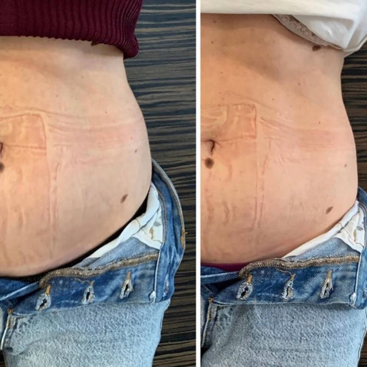 LIPOLYTIC INJECTIONS ( fat removal) NYC