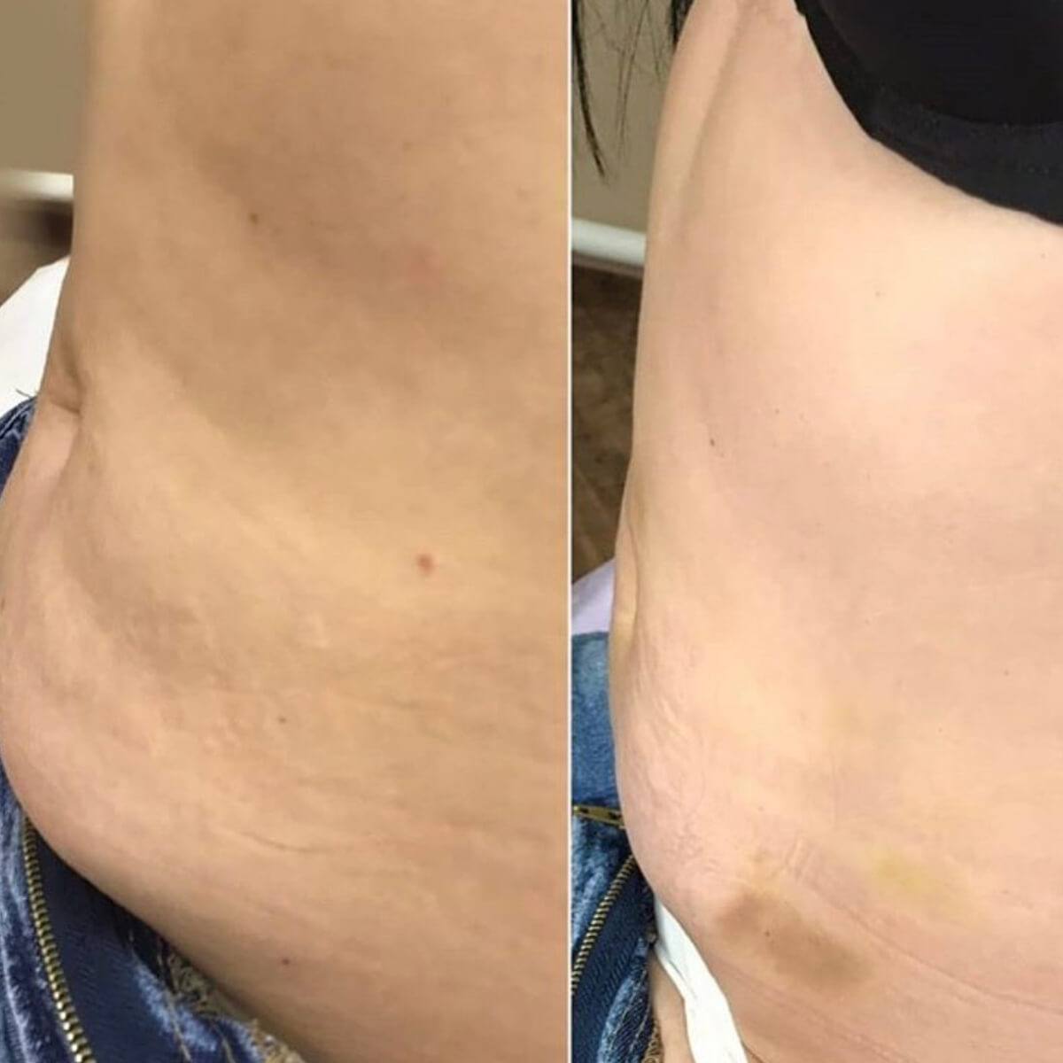 LIPOLYTIC INJECTIONS ( fat removal)