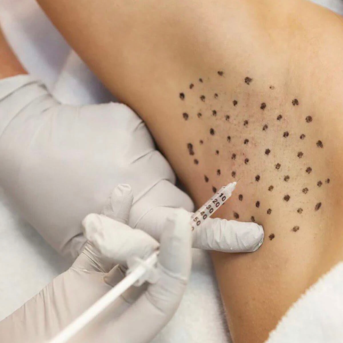 Hyperhidrosis New York | Treatment for Excessive Sweating - [WOWGIRLNYC®]