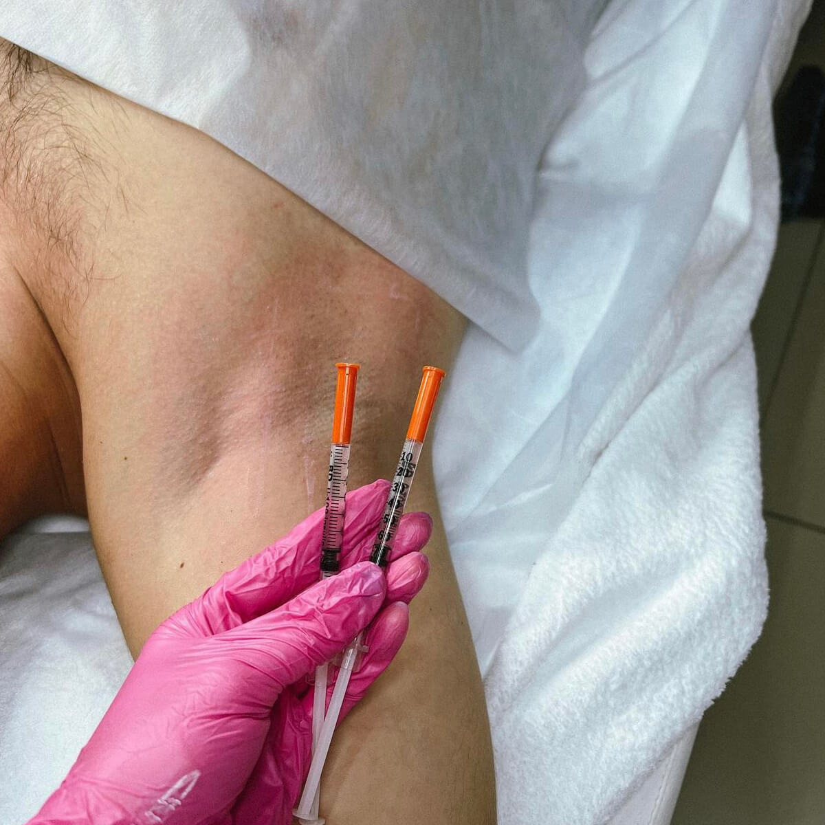 Hyperhidrosis New York | Treatment for Excessive Sweating - [WOWGIRLNYC®]