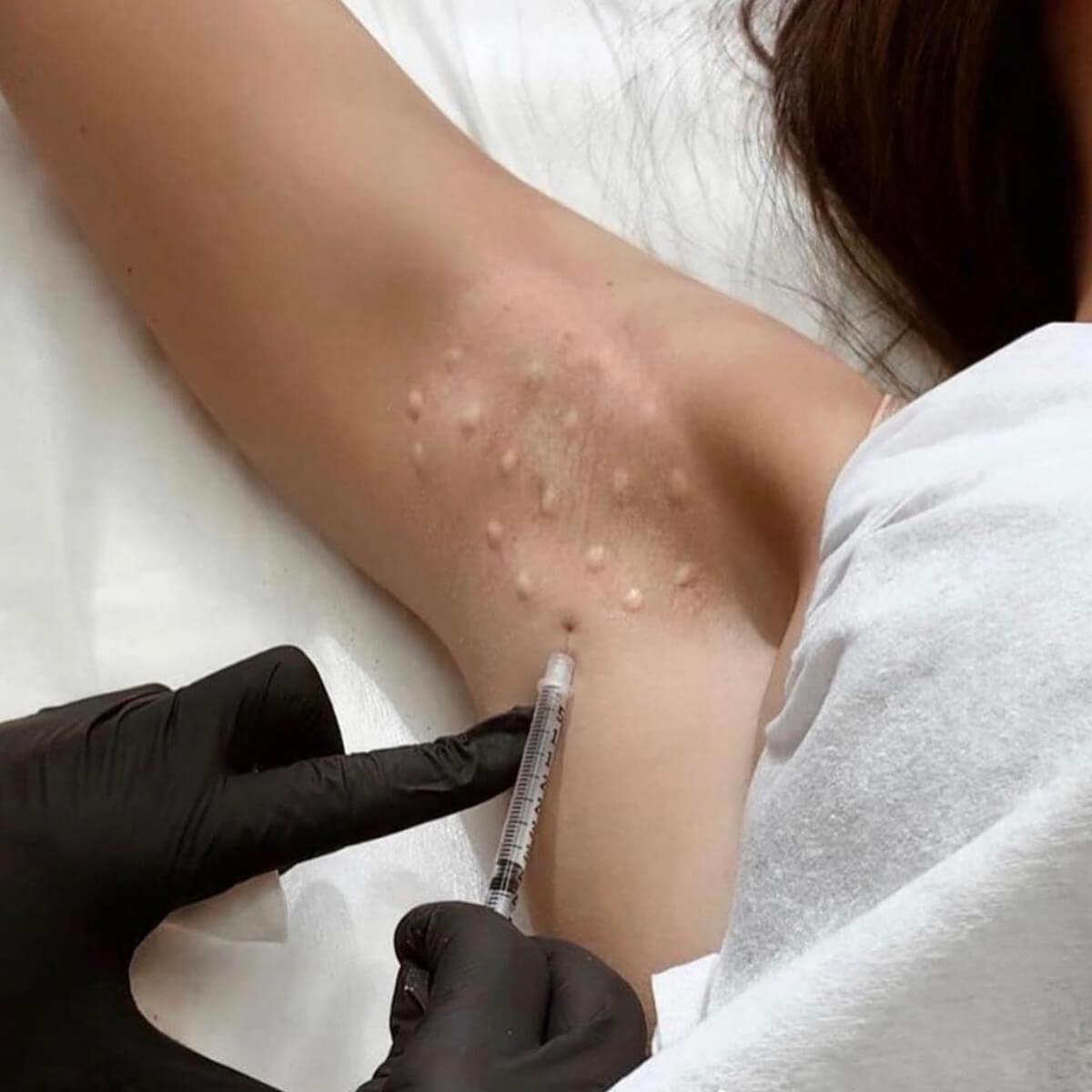 Hyperhidrosis New York | Treatment for Excessive Sweating - [WOWGIRLNYC®]