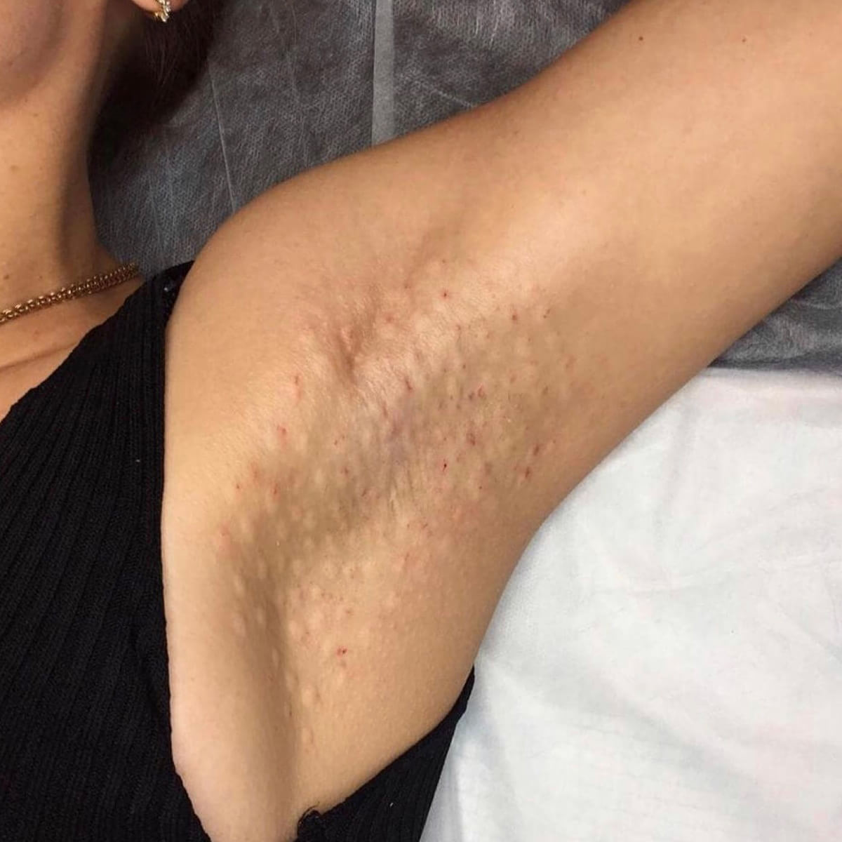 Hyperhidrosis New York | Treatment for Excessive Sweating - [WOWGIRLNYC®]