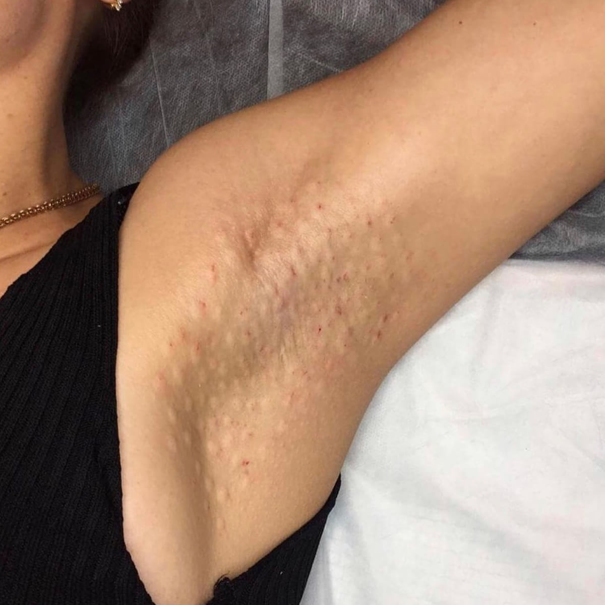 Hyperhidrosis New York | Treatment for Excessive Sweating - [WOWGIRLNYC®]