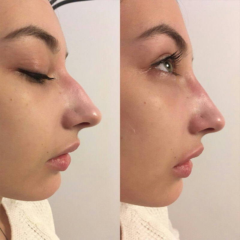 - Microblading Eyebrows in New York - Microblading training NASAL CONTOURING NEW YORK