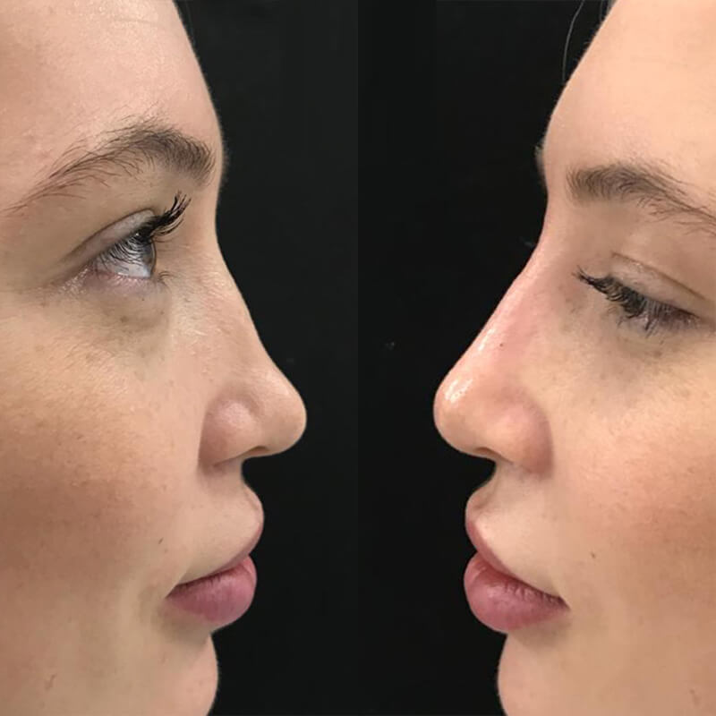 - Microblading Eyebrows in New York - Microblading training NASAL CONTOURING NEW YORK
