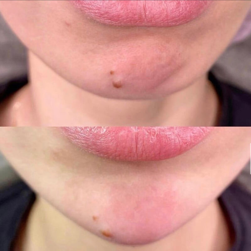 Chin & Jaw Contouring NEW YORK | NYC [WOWGIRLNYC®]