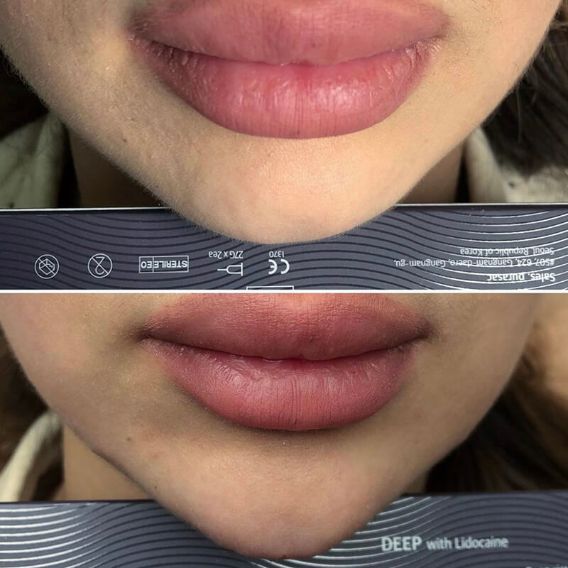 Chin & Jaw Contouring NEW YORK | NYC [WOWGIRLNYC®]