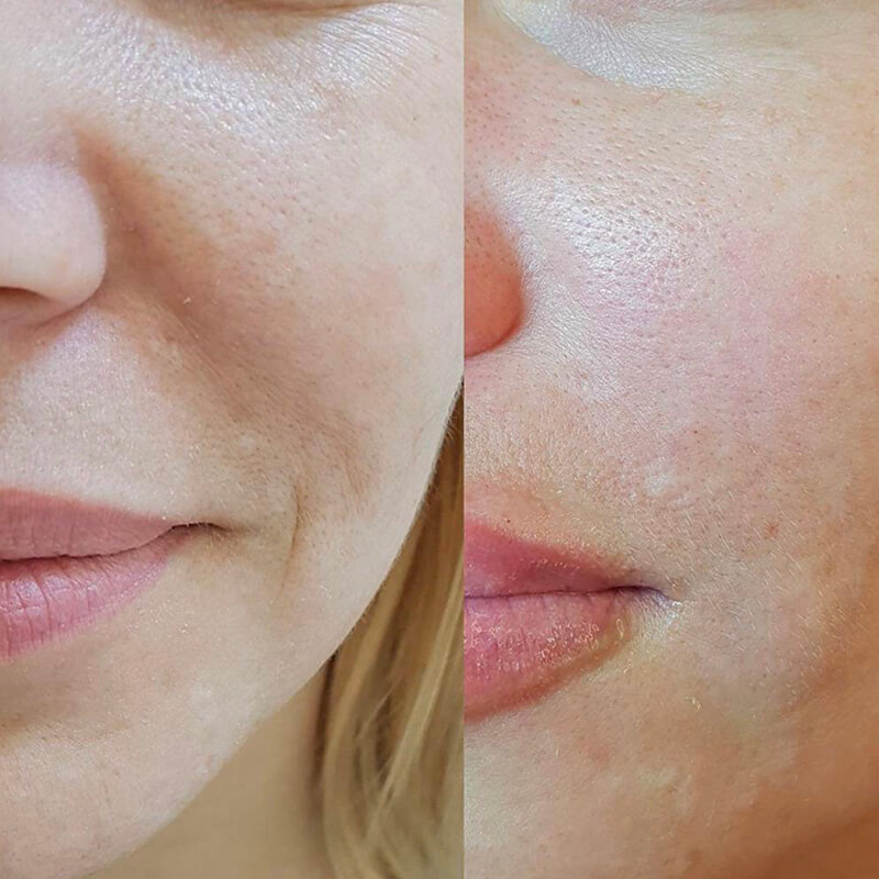 CONTOURING OF NASOLABIAL FOLDS NEW YORK | NYC [WOWGIRLNYC®]