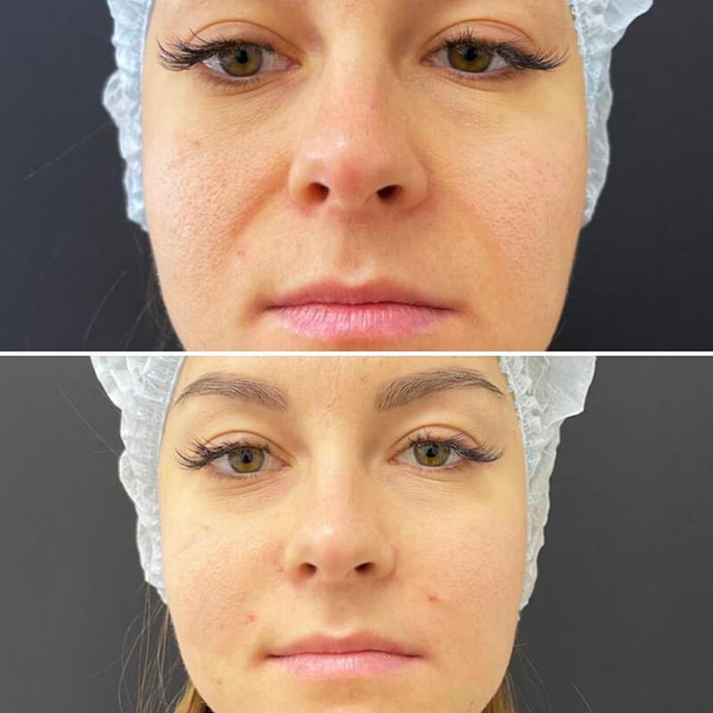 CONTOURING OF NASOLABIAL FOLDS NEW YORK | NYC [WOWGIRLNYC®]