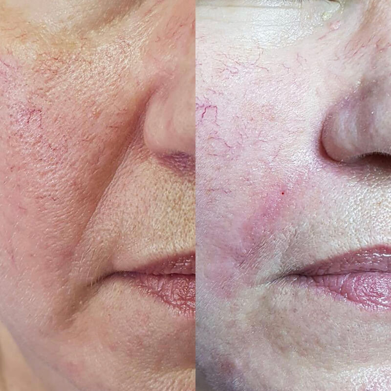 CONTOURING OF NASOLABIAL FOLDS NEW YORK | NYC [WOWGIRLNYC®]