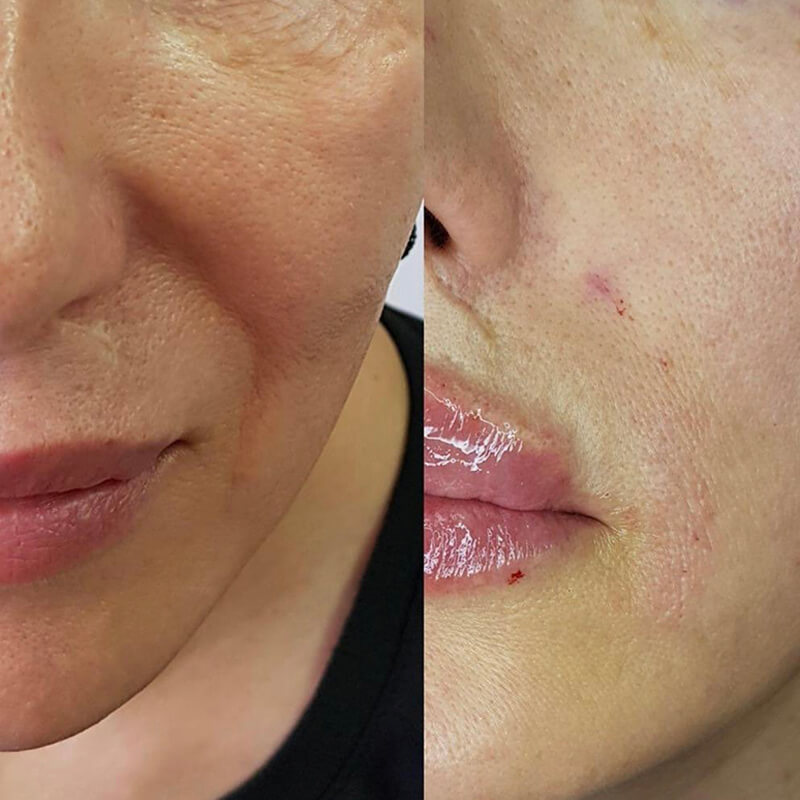 CONTOURING OF NASOLABIAL FOLDS NEW YORK | NYC [WOWGIRLNYC®]
