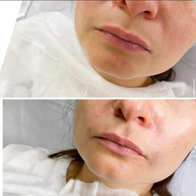 CONTOURING OF NASOLABIAL FOLDS NEW YORK | NYC [WOWGIRLNYC®]