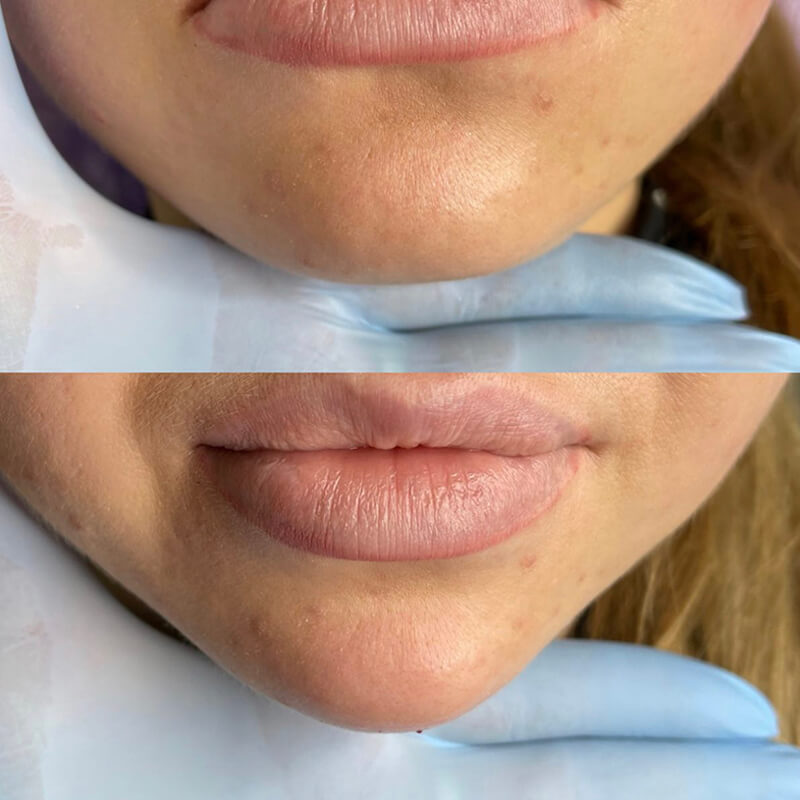 Chin & Jaw Contouring NEW YORK | NYC [WOWGIRLNYC®]