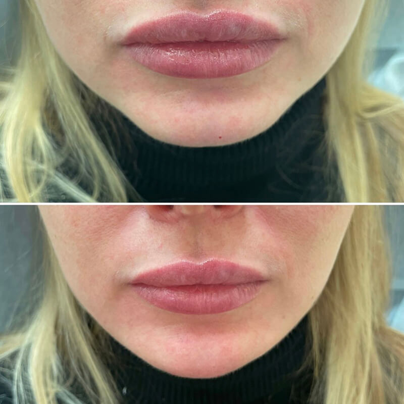 Chin & Jaw Contouring NEW YORK | NYC [WOWGIRLNYC®]