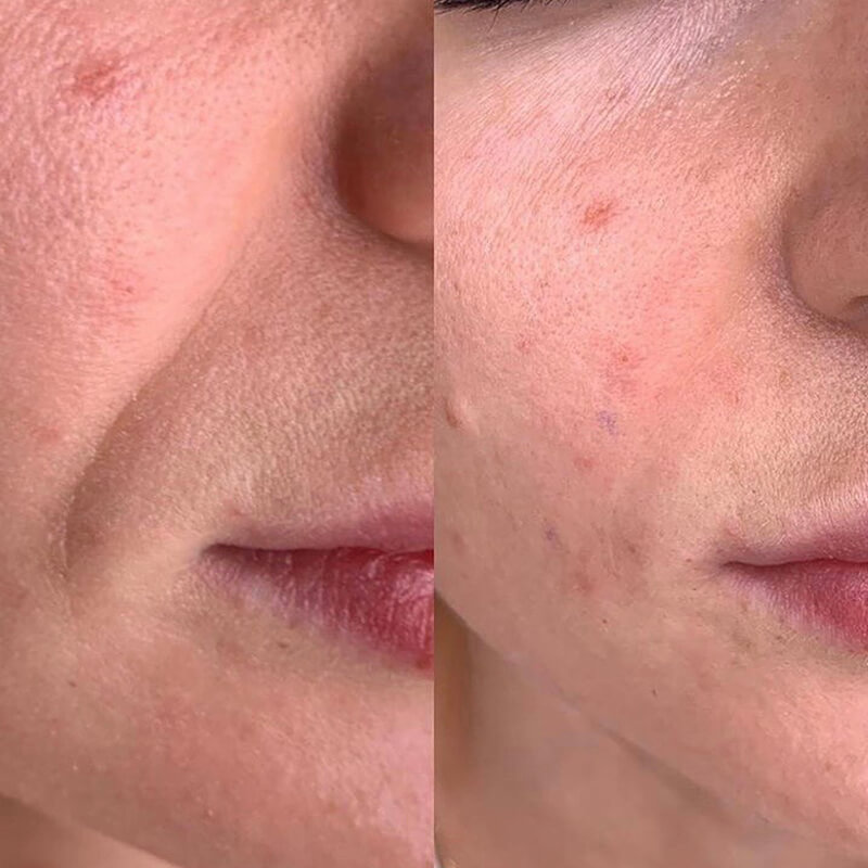 CONTOURING OF NASOLABIAL FOLDS NEW YORK | NYC [WOWGIRLNYC®]
