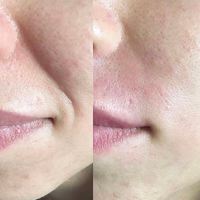 CONTOURING OF NASOLABIAL FOLDS NEW YORK | NYC [WOWGIRLNYC®]