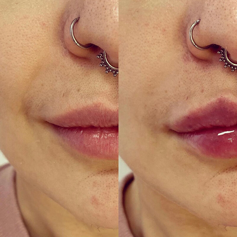 CONTOURING OF NASOLABIAL FOLDS NEW YORK | NYC [WOWGIRLNYC®]