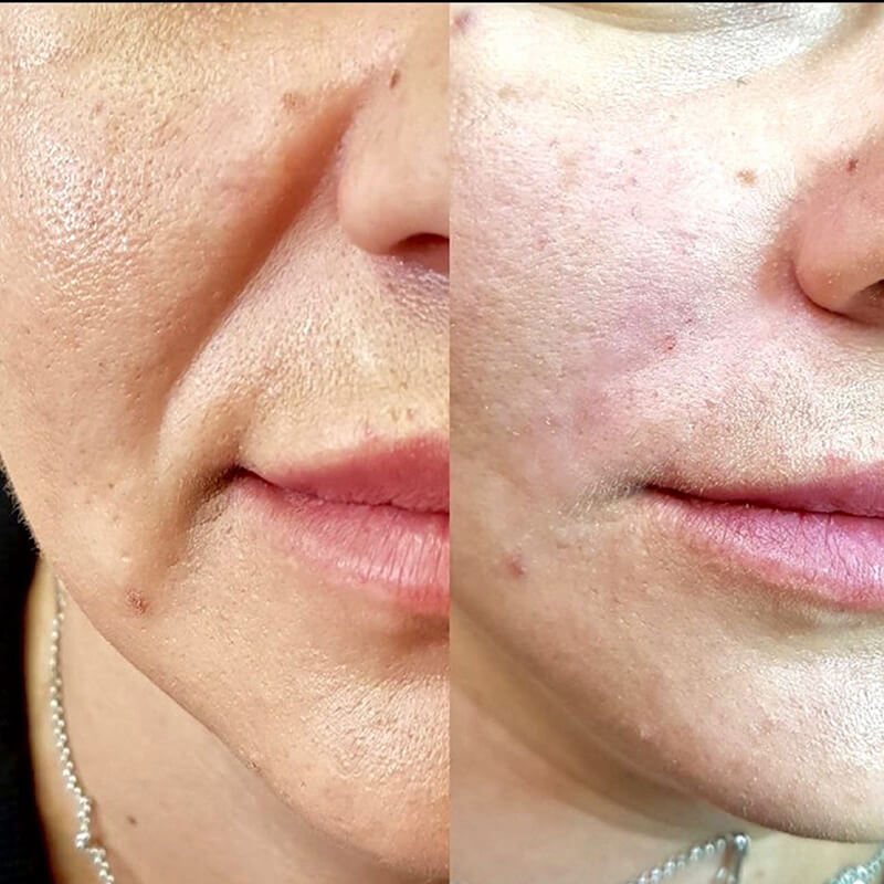 CONTOURING OF NASOLABIAL FOLDS NEW YORK | NYC [WOWGIRLNYC®]