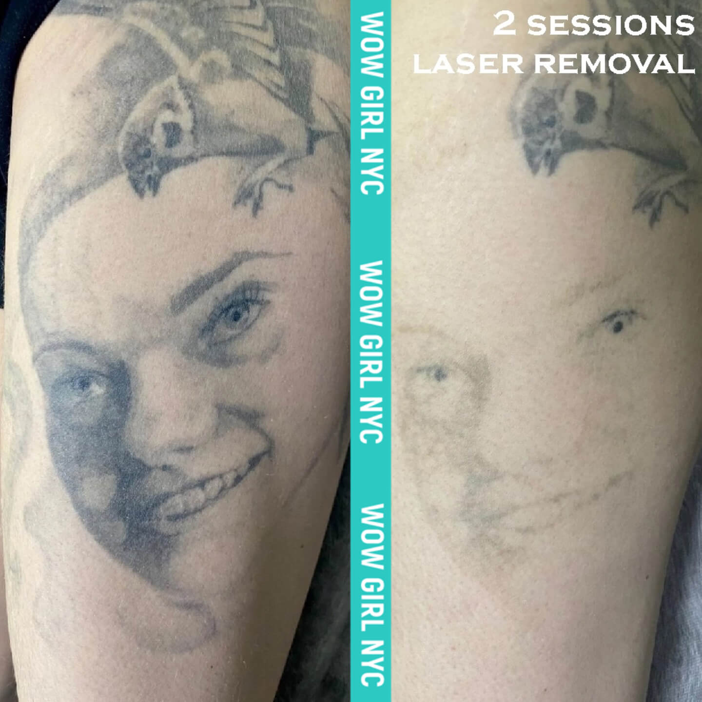 - Microblading Eyebrows in New York - Microblading training TATOO REMOVAL NEW YORK / NYC