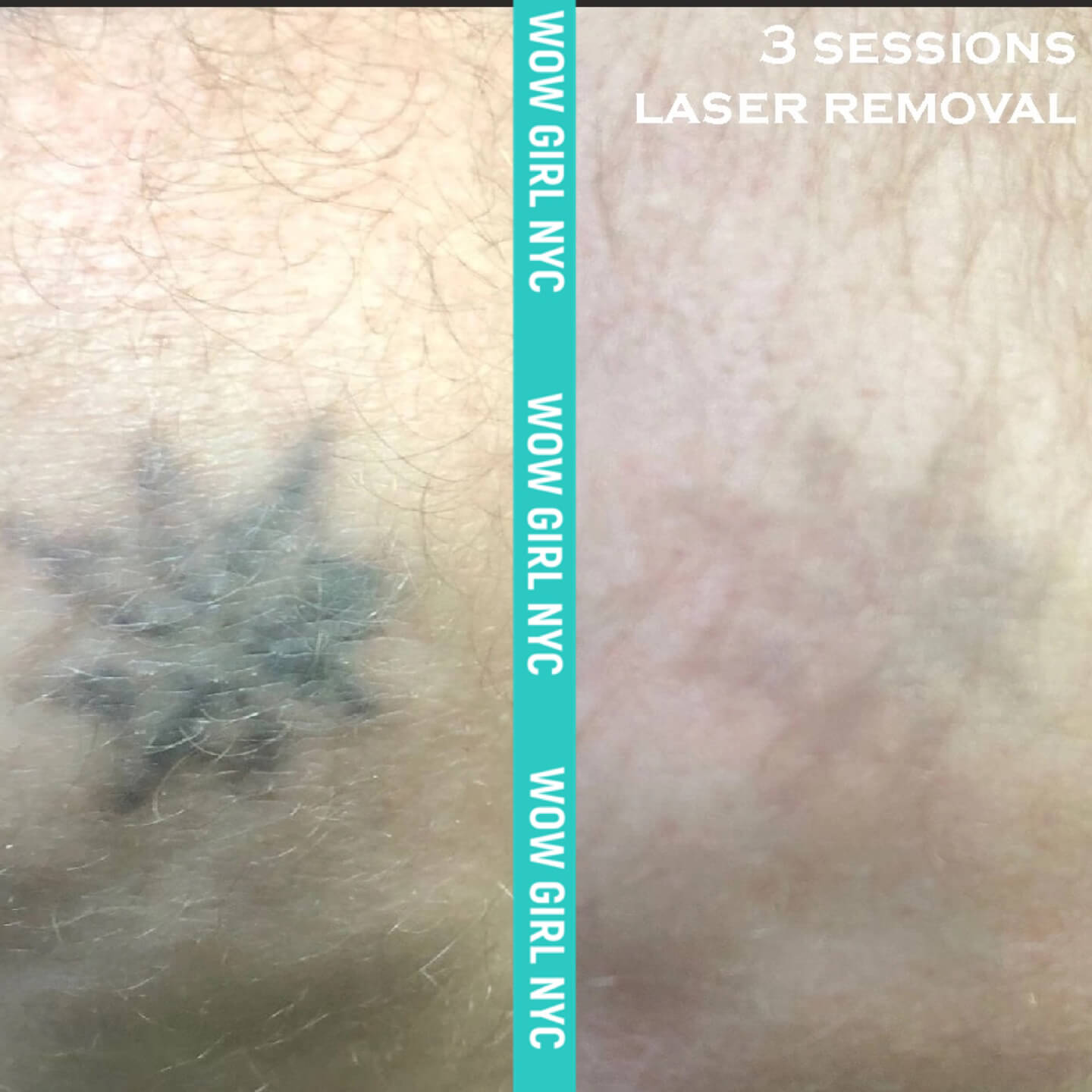 - Microblading Eyebrows in New York - Microblading training TATOO REMOVAL NEW YORK / NYC