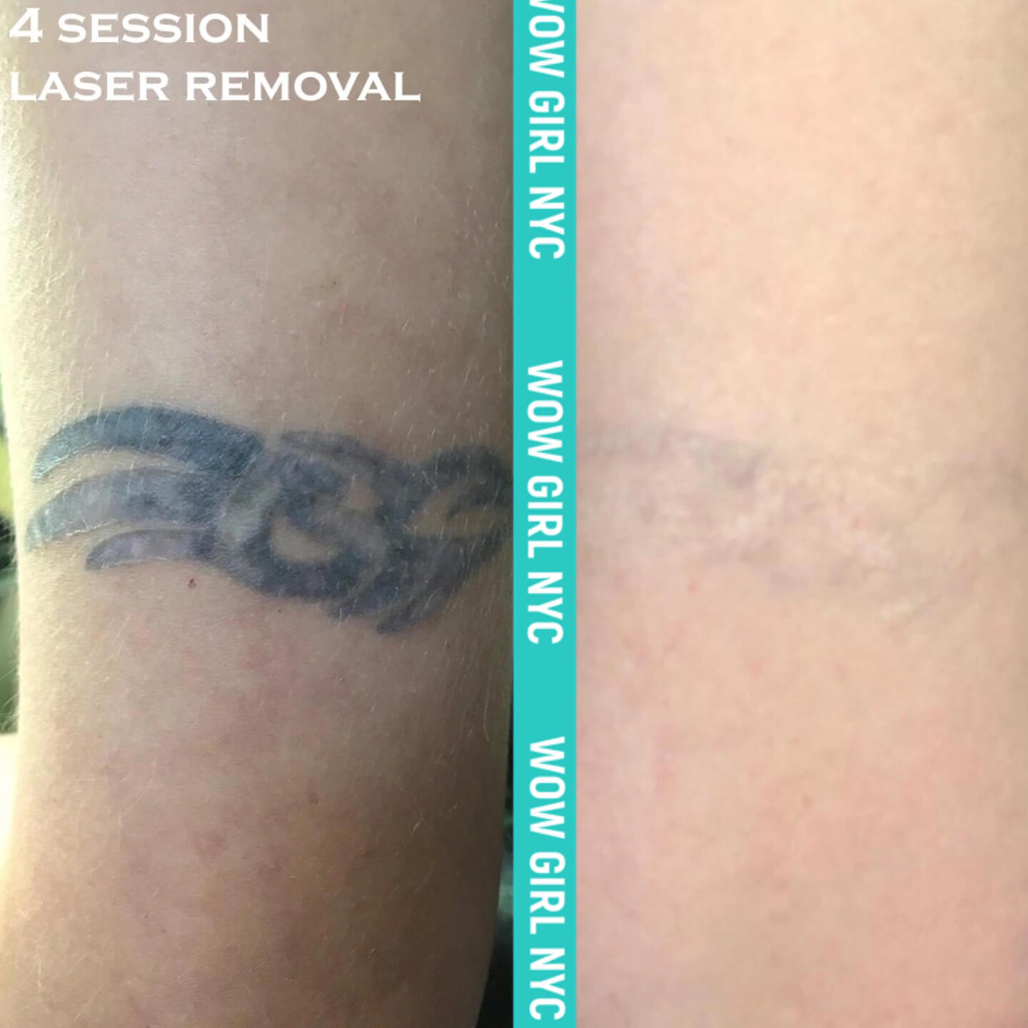 - Microblading Eyebrows in New York - Microblading training TATOO REMOVAL NEW YORK / NYC