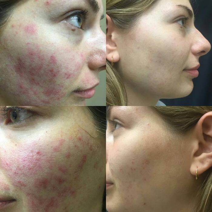 - Microblading Eyebrows in New York - Microblading training carbon peeling new york