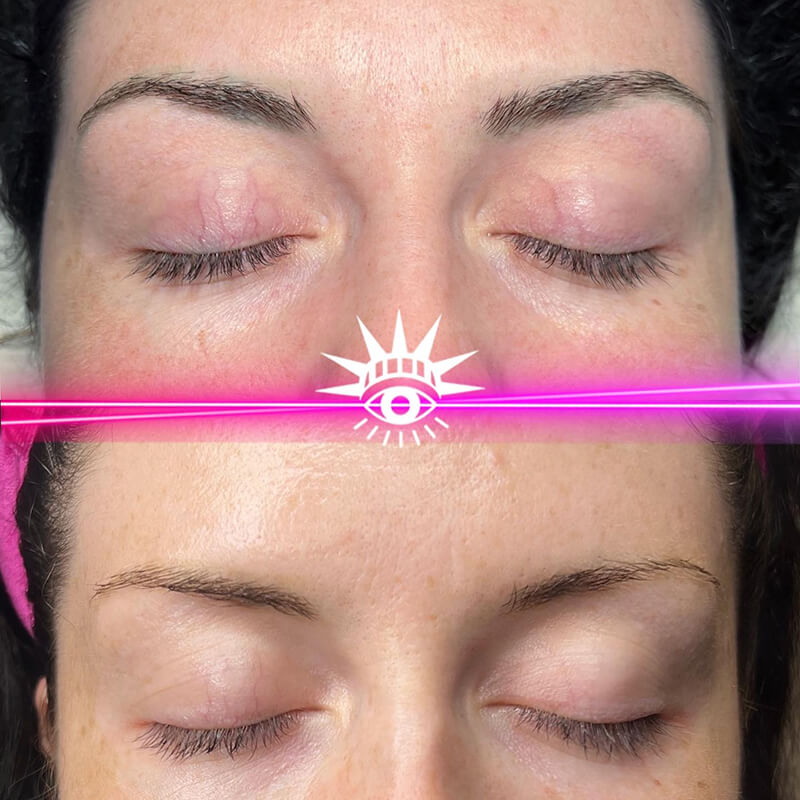 - Microblading Eyebrows in New York - Microblading training TATTOO REMOVAL EYEBROW