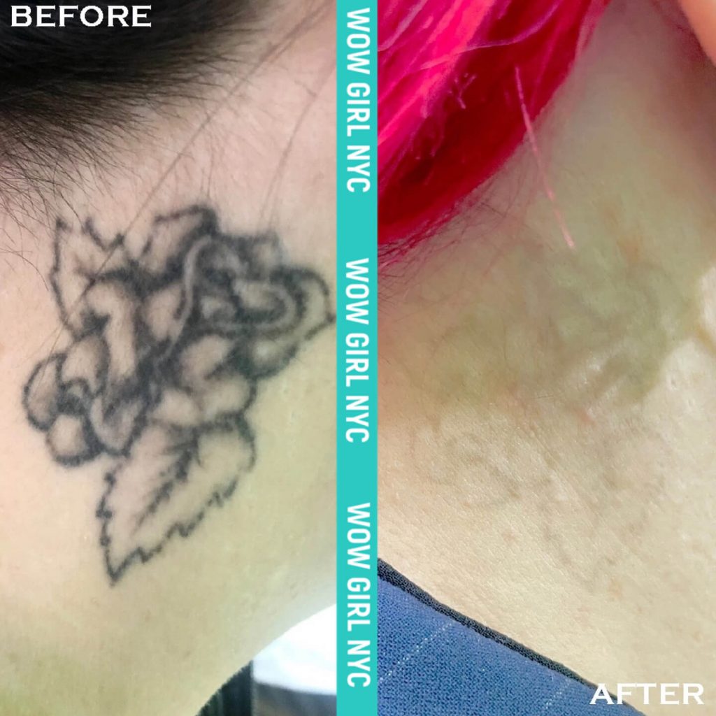 ᐉ Laser tattoo removal advantages and disadvantages