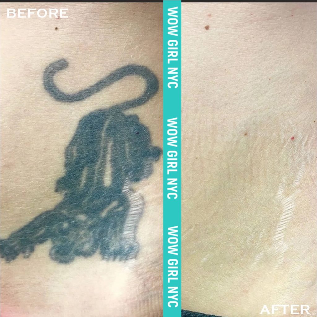 ᐉ Laser tattoo removal advantages and disadvantages